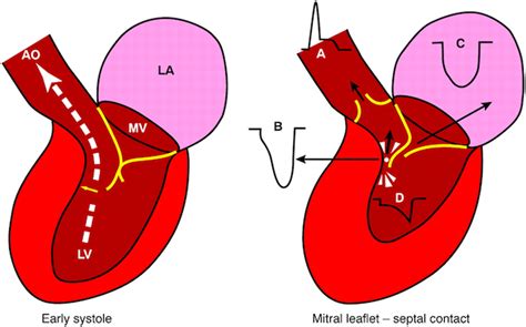 lv obstroction flow|ventricular outflow tract obstruction diagnosis.